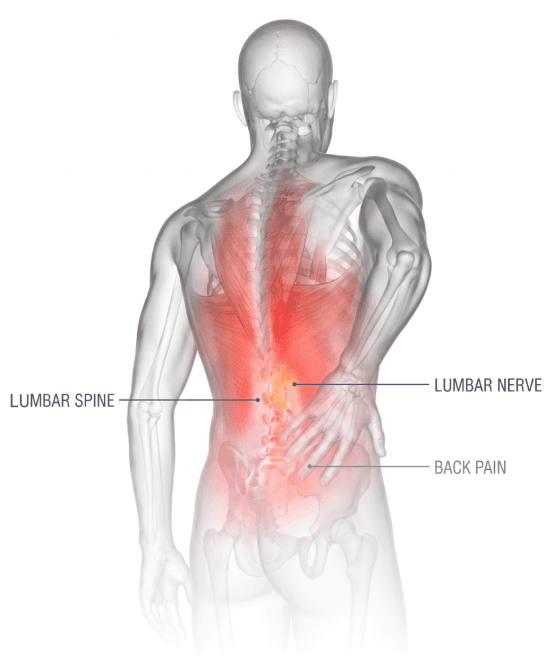Illustration of the lumbar spine and sciatic nerve pathway highlighting the sacroiliac joint, pelvis, and femur