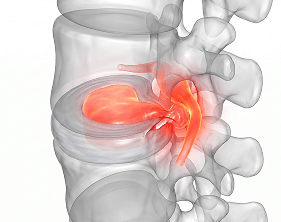 Disc under compression, pressing on the nerve root