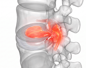 Disc under compression, pressing on the nerve root