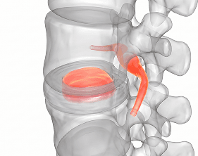 Disc under decompression, space restored and pressure relieved