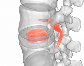 Disc under decompression, space restored and pressure relieved